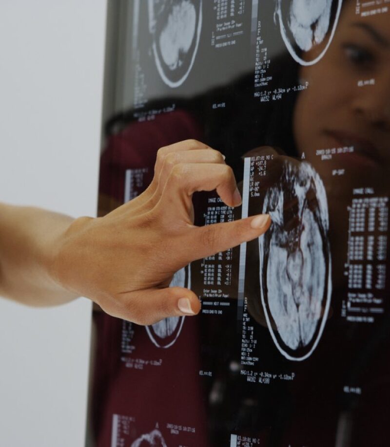 A person points at a brain scan image on a lightbox, with multiple black and white MRI scans of the brain displayed.